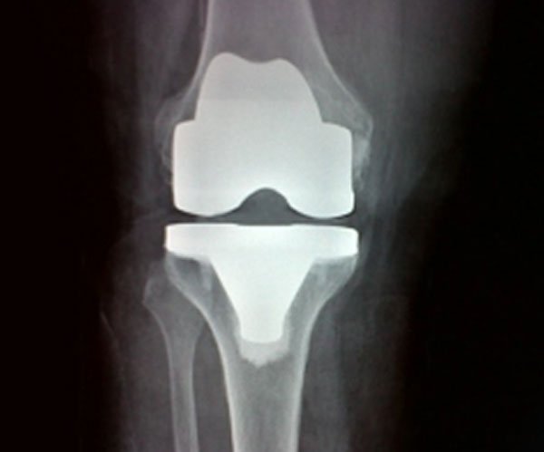 Cuvis Robotic - Implant Placement